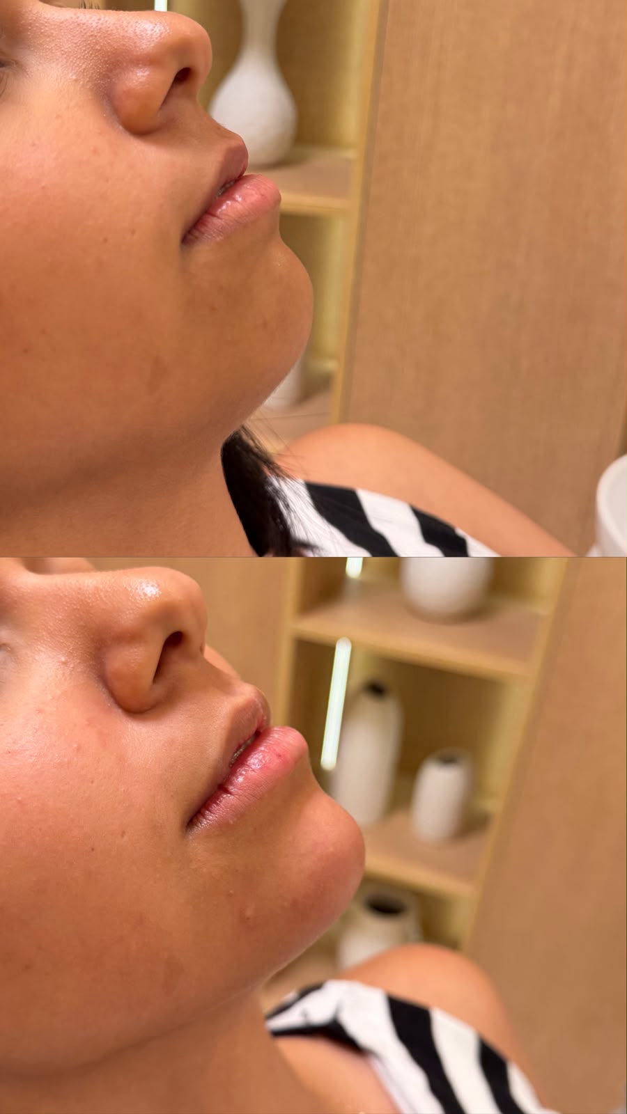 Antes e depois de preenchimento labial