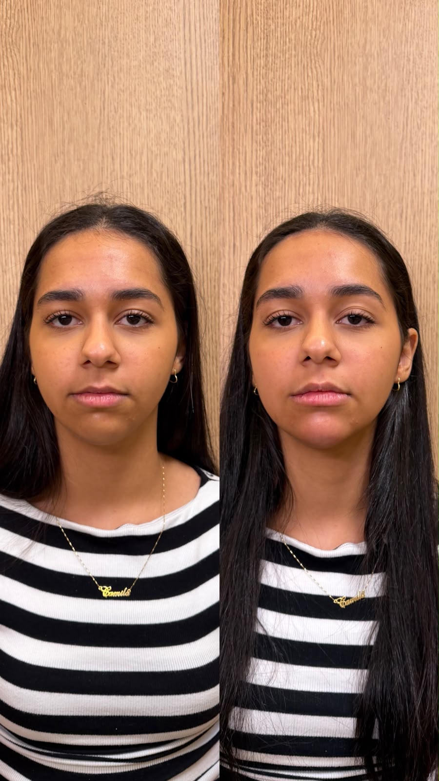 Antes e depois de harmonização orofacial