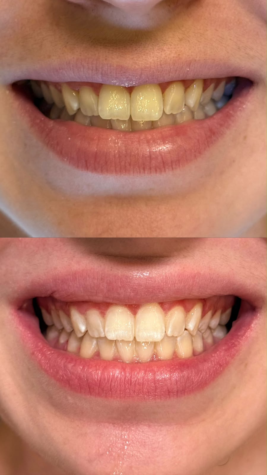 Antes e depois de clareamento dental