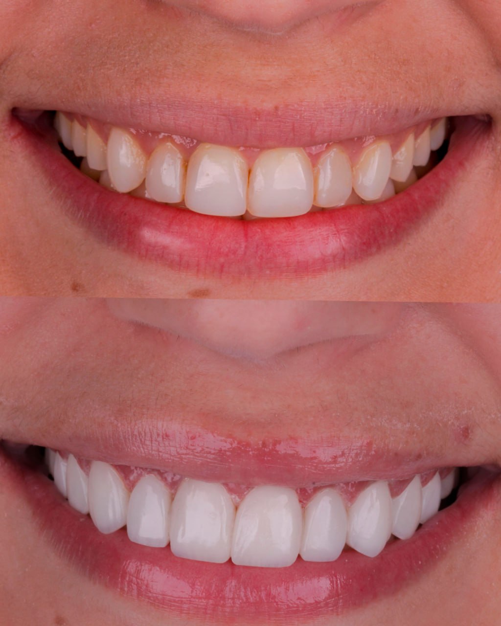 Antes e depois de facetas em resina